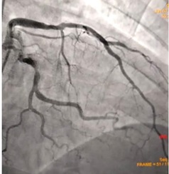 (Figura 2 -  Pós colocação de stent)