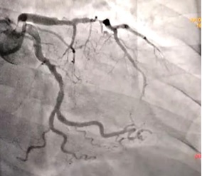 Figura 1 – suboclusão segmentar de ramo DA proximal